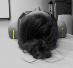 The pectoralis minor tightness assessment in asymptomatic and symptomatic shoulder groups.