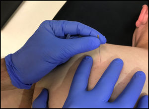 Example of trigger point dry needling administered to a left infraspinatus muscle.