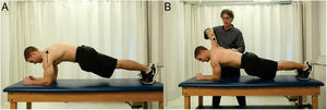 Push-up plus on elbows and toes: (A) bilateral, scapulothoracic protraction (thorax moving on fixed scapulae). (B) Left side shows subject holding relative scapulothoracic protraction; right side shows examiner resisting scapulothoracic protraction (arm and scapula protracting relative to fixed thorax).