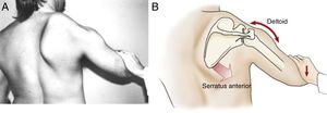 The pathomechanics of the winging right scapula after paralysis of the right serratus anterior caused by an injury of the long thoracic nerve. (A) The scapula is its downwardly rotated position, anteriorly tilted, and internally rotated. (B) Kinesiologic analysis of the extreme downward rotated position. Without an adequate upward rotation force from the serratus anterior (fading arrow), the scapula is not properly stabilized and cannot resist the pull of the deltoid. Subsequently the force of the deltoid (bidirectional arrow) causes the combined actions of downward rotation of the scapula and partial elevation (abduction) of the humerus.