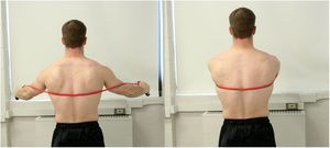 Dynamic hug exercise. Using elastic material as resistance, the subject performs bilateral, maximum scapular protraction.