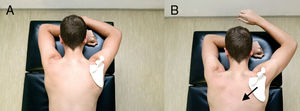 Prone scapular setting. Exercise starts with the individual lying in prone with the arm in overhead position resting on the treatment table (A). Position the scapula in relative retraction and depression (black arrow). While maintaining this scapular position, lift the arm slightly off the treatment table (B). Avoid shrugging the shoulder and activity of the upper trapezius.
