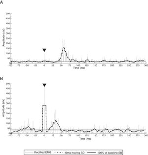 Sample EMG traces from participants who did not present with an analyzable CSP. (A) Ipsilesional EMG traces from participant 1 and (B) ipsilesional EMG traces from participant 4. Gray line represents rectified EMG; black dotted line represents 10ms moving SD EMG activity; black full line represents baseline threshold; EMG, electromyography; SD, standard deviation.