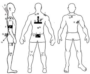 Setup of the active markers, clusters, electromyography electrodes, inclinometer and forward shoulder posture calculation. Active markers placed on the spinous process of the C7 (A); posterior (B) and anterior (C) borders of the acromion; the middle point between the anterior and posterior borders of the acromion (D). Forward shoulder posture angle (E). Clusters placed on the arm (F), trunk (G), and sacrum (H). EMG electrodes placed on the upper trapezius (I); lower trapezius (J); and serratus anterior (K); electrode placed on the thigh (L); reference EMG electrodes placed on the spinous process of T2 (M) and T10 (N), on the manubrium of the sternum (O), and on the lateral condyle of the femur (P); inclinometer placed over the sacrum (Q).