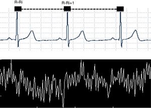 Illustration of an electrocardiogram tracing with R-R intervals (R-Ri) in milliseconds (upper) and a tachogram formed from a time series of collected R-Ri (lower).