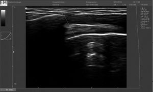 AHD measurement on the ultrasound image.