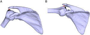 The spatial relationship between the minimum distance vector (red) and the rotator cuff tendon insertion (black area on humeral surface). (A) At 30° of humerothoracic elevation, the minimum distance vector is located within the rotator cuff tendon insertion, which suggests the rotator cuff may be in a position to become compressed and/or abraded. (B) At 90° of humerothoracic elevation, the minimum distance vector is located lateral to the rotator cuff tendon insertion, which suggests the rotator cuff tendon has already cleared the lateral acromion and is no longer in a position to be compressed and/or abraded.