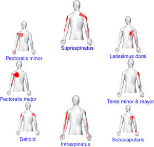 Referred pain pattern from the neck and shoulder muscles explored in the current study: supraspinatus, latissimus dorsi, teres minor, teres major, subscapularis, infraspinatus, deltoid, pectoralis major and pectoralis minor muscles.