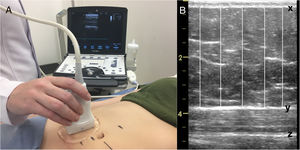 (A) Ultrasound measurement, (B) image measurement: (x) internal border of the dermis, (y) superficial aponeurosis of the rectus abdominis muscle and (z) inferior aponeurosis of the rectus abdominis muscle.