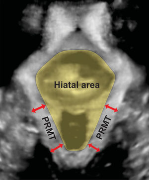 3D translabial ultrasound image of hiatal area (in yellow) and four measurement sites of puborectalis muscle thickness (PRMT).