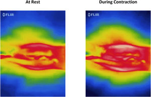 Infrared thermography of a single woman at rest and during muscle contraction. It shows an increasing amount of red color in the center of the image during pelvic floor muscles contraction.