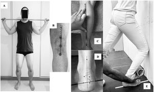 (A) Position for assessment of Arno angle; (B) Arno angle measurement (indicating lateral patellar rotation in a left lower limb in the figure); (C) shank bisection for shank-forefoot alignment measurement (left lower limb); (D) shank-forefoot alignment measurement (left lower limb); and (E) ankle dorsiflexion range of motion measurement.