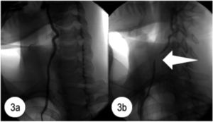 Angiogram of the right vertebral artery. Fig. 3a shows the normal appearance of the right vertebral artery during the angiogram performed in neutral head position. Fig. 3b shows evidence of flow disruption (level of C7) during the angiogram performed in right head rotation. Reprinted from Lee et al.,21copyright 2011, with permission from Elsevier.