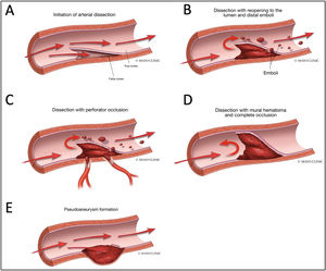 Various Manifestations of Intracranial Dissections. A. During initiation of the arterial dissection blood dissects into the subintimal space to create a false lumen to create an intramural haematoma. B. If there is an exit site for the dissection then a true and false lumen appear. There can be emboli from the intramural haematoma in the false lumen that result in embolic stroke. C. If the intramural haematoma involves the origin of perforator vessels, perforator occlusion can occur. D. If the intramural haematoma lacks an exit site, it can build up to eventually cause occlusion of the parent artery. E. If the haematoma breaks through the adventitia then pseudoaneurysm formation can occur. Reproduced with authorization from Bond et al.,28copyright © Elsevier Masson SAS.