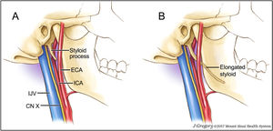 A: Normal length styloid process and associated vascular and neural structures. Fig. 7B: Elongated styloid process travelling just proximal to the carotid bifurcation as seen in patients with Eagle syndrome. ICA = internal carotid artery. ECA = external carotid artery. IJV = internal jugular vein. CN X = cranial nerve 10 – vagus nerve. Image by Jill Gregory,48 reprinted with permission from ©Mount Sinai Health System.