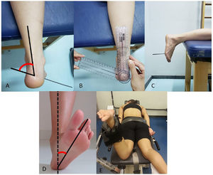 Superior view (A and B) and lateral view (C) of the measurement of the foot-ankle alignment. This clinical measure provides the forefoot-shank angle, measured in open chain. The black lines in A represent the alignments of the forefoot (heads of the metatarsals) and shank, and the red arc represents the angle between the forefoot and tibia. (D): The foot abduction angle (in red) determined by the angle of the rearfoot (continuous line) relative to the laboratory (dashed line), in the transverse plane, at the initial contact of walking. (E): Participant positioning during the measurements of hip passive stiffness and eccentric strength of the hip external rotators.