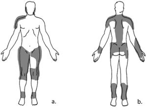 Sarah’s drawing of her pain locations on a front (a) and back (b) diagram.