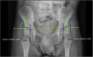 Calculation of the Reimers migration percentage index. H: Hilgenreiner line; P: Perkins line; A: distance between Perkins line and the outermost line of the femoral head; B: distance between the two lines that form the femoral head.