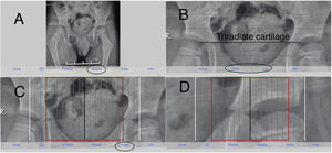 HipScreen interface layout. A: Rotate function. B: Gray line representing the Hilgenreiner line. C: Ruler function. D: The white line is positioned on the lateral side of the femoral head and the black line in the medial portion of the femoral head.