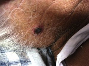 Blackish skin lesion on the right side of the patient's neck.