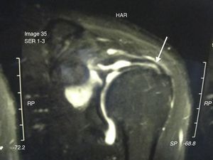 T2-weighted MRI study of the left shoulder performed three months after levofloxacin exposure shows a supraspinatus tendon tear (arrow), corresponding to a 40%-50% thinning, near its insertion on the greater tuberosity of the humerus.