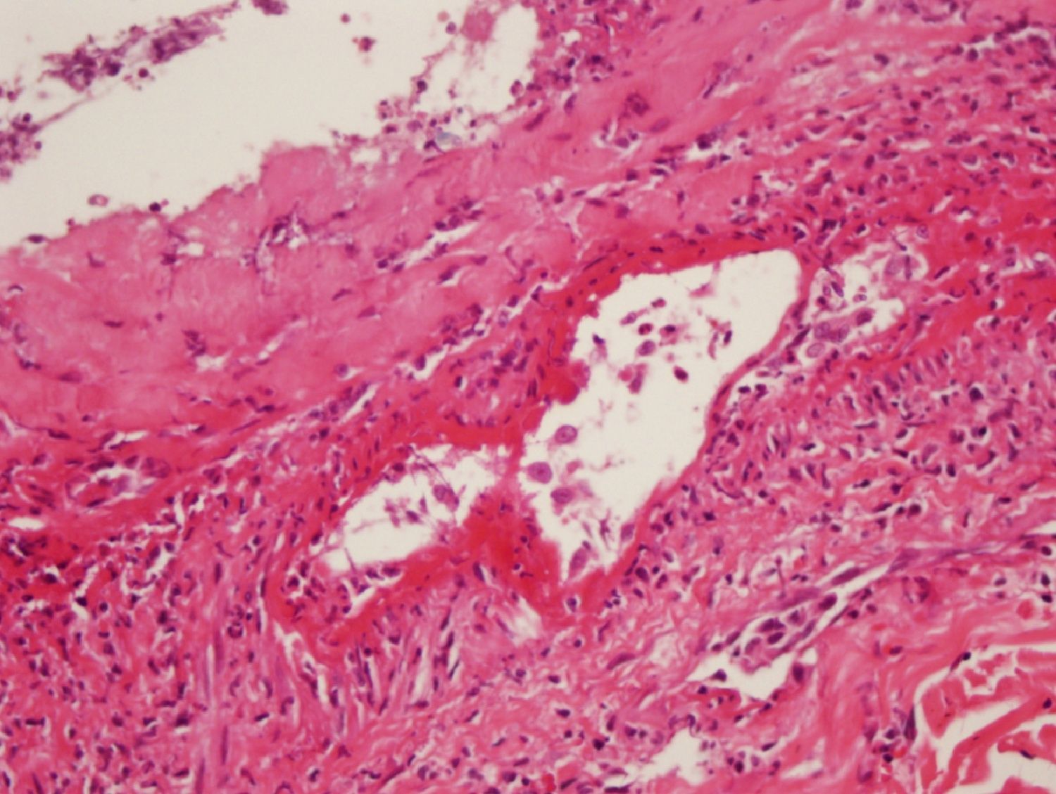 Cytomegalovirus (CMV)-related cutaneous necrotizing vasculitis: case ...