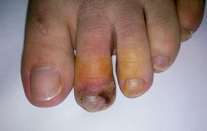 Necrotic appearance of the tip of the second toe of patient's right foot with purple to bluish discoloration.