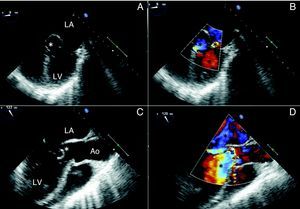 Preoperative transesophageal echocardiography demonstrating severe damage to the aortic and mitral valve with severe regurgitation (B, D). (A) The extended abscess formation is indexed(*) and (B) duplex shows regurgitation jets(*). (C) The aorto-mitral continuity was totally destroyed(*) and blood was shunting from the aorta to the left atrium (D).