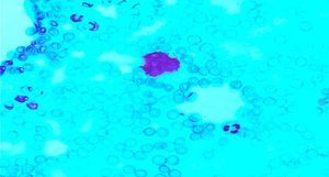 Ring forms of Babesia parasite in an intraerythrocytic position in our patient.