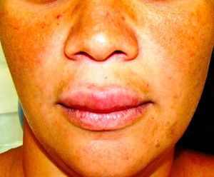 The lesion in upper lip was granulomatous cheilitis-like.