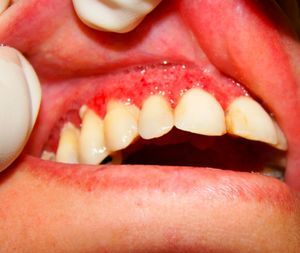 Presence of multiple painful moriform ulcers in the upper gum, palate, and upper lip.