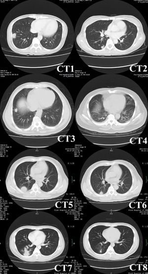 Chest CT images of pulmonary cryptococcosis. CT1 (patient No. 13) showing a mass with lobulation, short spikes and focal pleural adhesion and thickening in right lower lobe. CT2 (patient No.13, different scan levels of CT1) showing multiple nodules of variable sizes in right lung beneath the pleura. CT3 (patient No. 16) showing a solitary nodule with short spikes and pleural stretching in antero-basal section of the right lung. CT4 (patient No. 11) showing patchy consolidations in the dorsal lower lobes of bilateral lungs that were vaguely circumscribed and adjacent to the pleura. CT5 (patient No. 20) showing a mass with halo sign. CT6 obtained at the same level as CT5 showing lesion shrunk significantly after administering fluconazole for three months. CT7 (patient No. 22) showing multiple nodules in right lower lobe. CT8 obtained at the same level as CT7 showing resolution of lesions after applying fluconazole for one month.