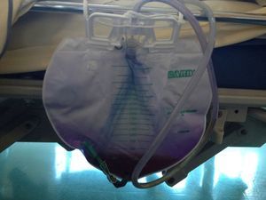 Photograph of the purple coloration of the indwelling catheter and urine bag.
