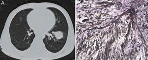 (A) Chest CT scan showed a mass in lower lobe of the left lung. (B) Broad, irregularly branched and non-septate hyphae with positive methenamine silver stain observed in lung tissue (magnification,×40).