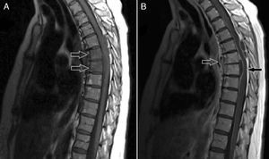 (A) Non-contrast T1 magnetic resonance imaging (MRI) of thoracic spine revealing signal abnormalities of the bodies of T6 and T7 vertebrae consistent with osteomyelitis. (B) Contrast-enhanced T1 MRI showing multiple abscesses.