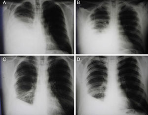 Patient no. 1. (A) Chest X-ray performed before treatment. (B) Chest X-ray performed after inserting drain. (C) Chest X-ray performed after introducing two doses of Pulmozyme. (D) Chest X-ray performed after removing drain.