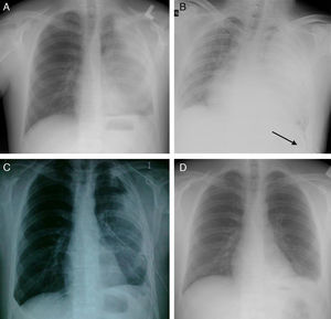 Patient no. 2. (A) Chest X-ray performed before treatment. (B) Chest X-ray performed after inserting drain. (C) Chest X-ray performed after introducing two doses of Pulmozyme. (D) Chest X-ray performed after removing drain.