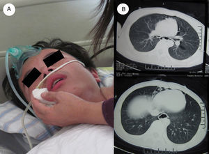 (A) The patient presented with a fluctuating consciousness, as well as difficultly in swallowing of the saliva. (B) Over-inflation of the esophagus lumen as well as pneumomediastinum around the heart and sheaths of large vessels.