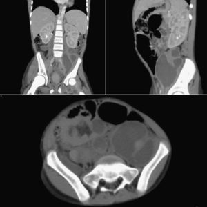 Abdominal computerized tomography showing multiple retroperitoneal lymphadenopathies.