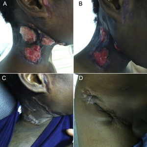 Cervical nodular formations at days 4 (A) and 22 (B) of posaconazole therapy, along with cervical (C) and inguinal (D) regions after complete cicatrization.