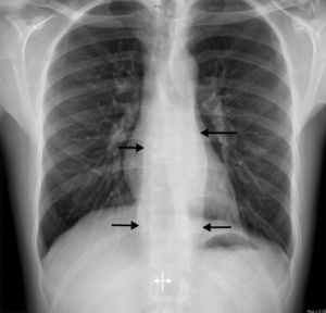 Chest X-ray imagination showing the borders of abscess which mimicks aortic aneurism.