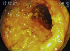 Colonoscopy showing cecal stenosis with diffuse polypoid lesions.