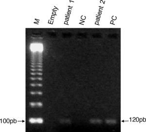 Identification of 120bp of the conserved region of the Leishmania minicircle-kDNA in bone marrow aspirates from newborns using polymerase chain reaction (PCR) revealed in 2% agarose gel stained with ethidium bromide. Lane 1: molecular weight ladder (M); lane 2: empty; lanes 3 and 5: bone marrow from newborns 1 and 2, respectively; lane 4: negative control (NC) without DNA; lane 6: positive control (PC) consisting of cultured promastigotes of Leishmania chagasi (syn. Leishmania infantum).