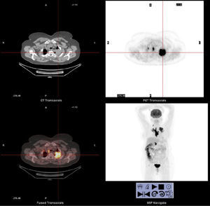 The PET/CT images of the first case revealed a mass lesion with a high FDG uptake.