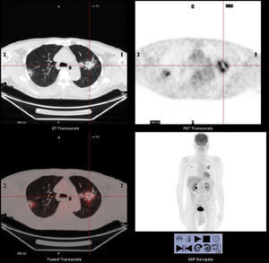 The PET/CT images of the second case revealed a mass lesion in the left upper lobe with a high FDG uptake.