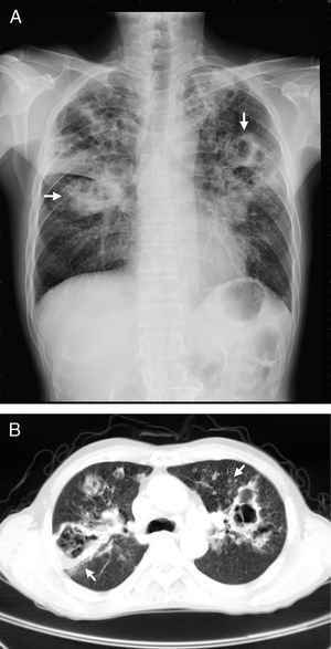 Chest radiography (A) and computed tomography (B): multiple cavities of various sizes and segmental consolidations, mainly in the upper lungs (arrows).
