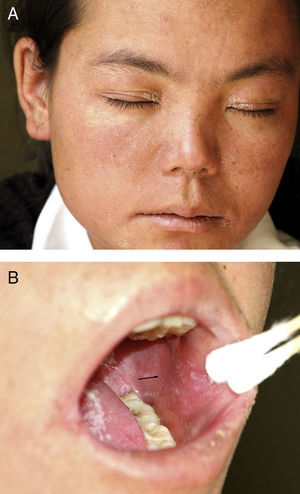 (A) Notable exudate around eyes, alae nasi and oral lips and (B) small white spots on the buccal mucosa that resembled grains of salt and had a reddish background.