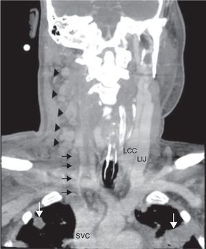 Coronal image from a contrast-enhanced neck CT scan shows thrombosis of the right internal jugular vein (arrows), multiple enlarged lymph nodes along the jugular chain (black arrowheads) and multiple focal lesions in the upper lobes (long arrows). SVC, superior vena cava.