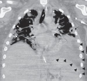 Coronal CT image of the thorax shows multiple peripheral nodular lesions in the lungs (white arrows) with areas of central cavitation (black arrow) consistent with septic emboli, left lower lobe consolidation and high-density effusion suggesting empyema (arrowheads).