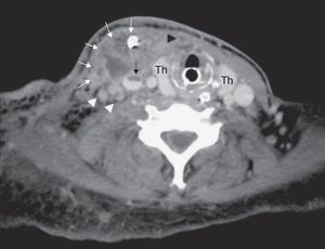 Post-operative CT at the level of the thyroid gland (Th) shows a complex abscess in the right sternocleidomastoid muscle with drain in situ (white arrows). Notice the partially thrombosed right jugular vein (black arrow), completely thrombosed anterior jugular vein (black arrowhead) and enlarged right internal jugular lymph nodes (white arrowheads).
